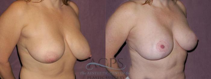Before & After Breast Reduction Case 1139 Oblique Right View: View in Houston, TX