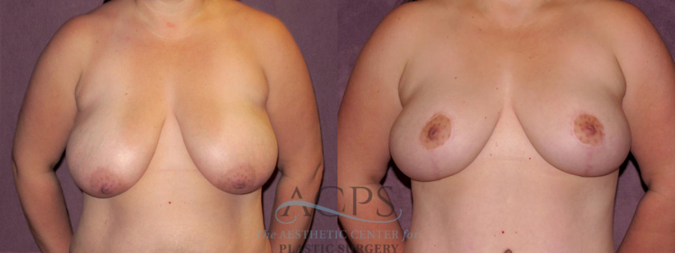 Before & After Breast Lift Case 1141 Front View: View in Houston, TX