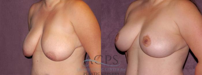 Before & After Breast Lift Case 1141 Oblique Left View: View in Houston, TX