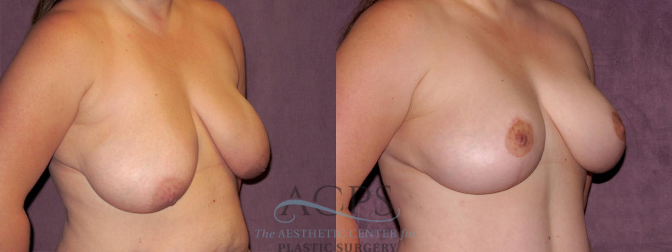 Before & After Breast Lift Case 1141 Oblique Right View: View in Houston, TX