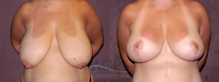 Before & After Breast Reduction Case 1142 Front View: View in Houston, TX