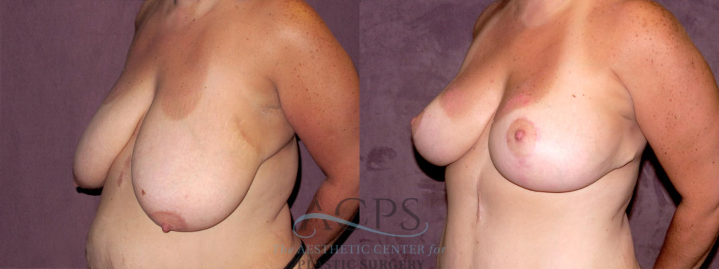 Before & After Breast Reduction Case 1142 Oblique Left View: View in Houston, TX