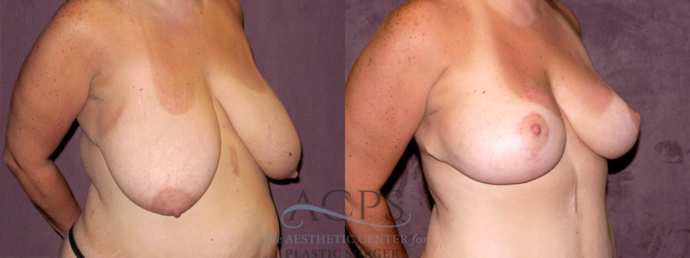 Before & After Breast Reduction Case 1142 Oblique Right View: View in Houston, TX