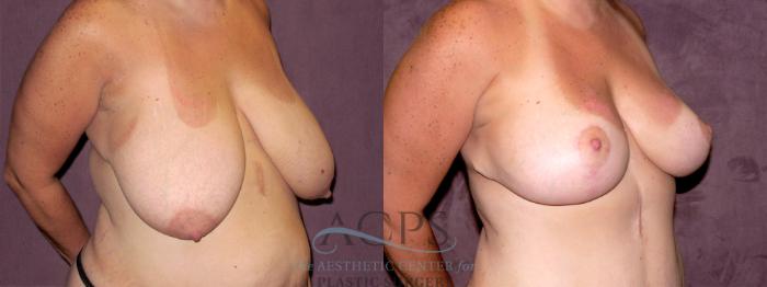 Before & After Breast Reduction Case 1142 Oblique Right View: View in Houston, TX