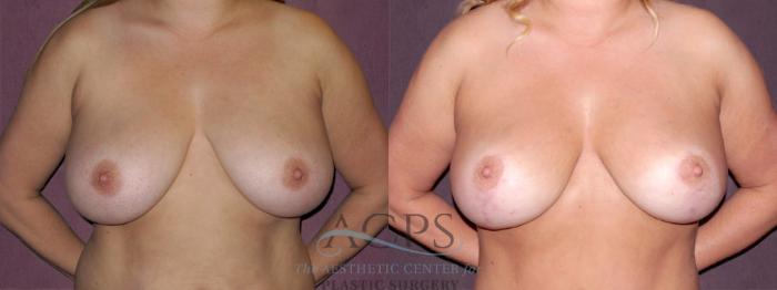 Before & After Breast Lift Case 1143 Front View: View in Houston, TX
