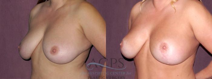 Before & After Breast Lift Case 1143 Oblique Left View: View in Houston, TX