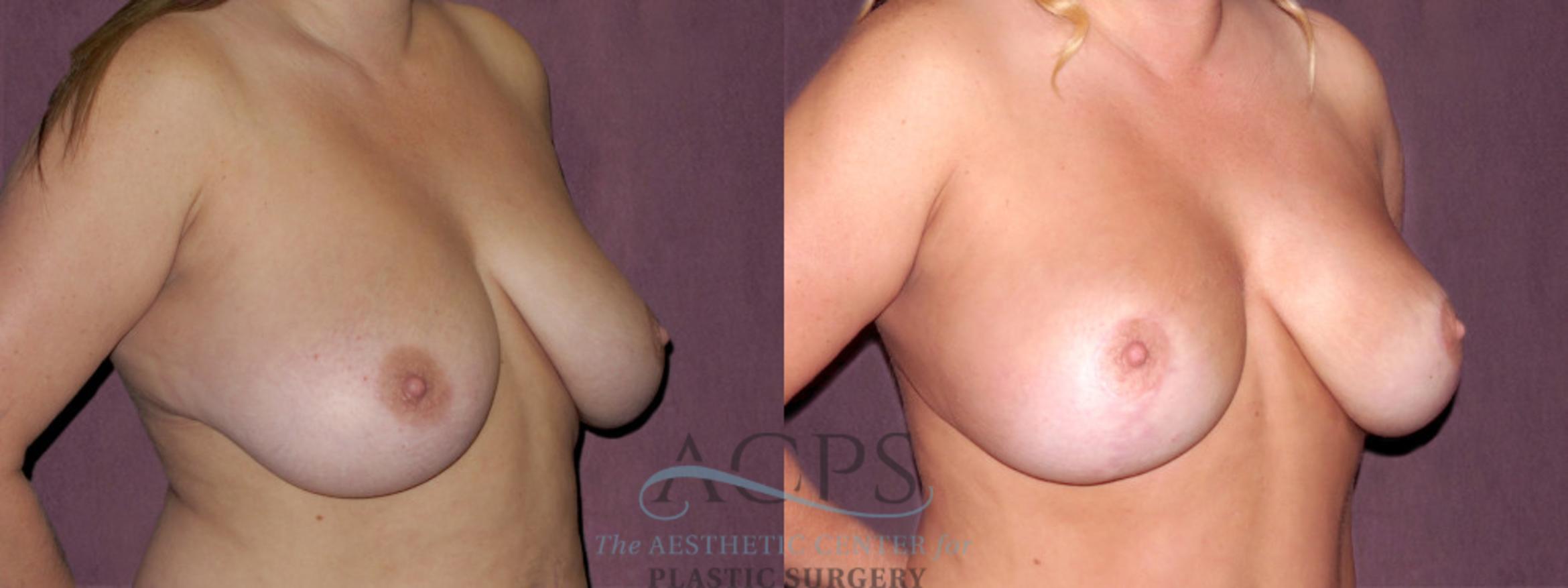 Before & After Breast Lift Case 1143 Oblique Right View: View in Houston, TX