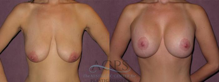Before & After Breast Lift Case 1144 Front View: View in Houston, TX
