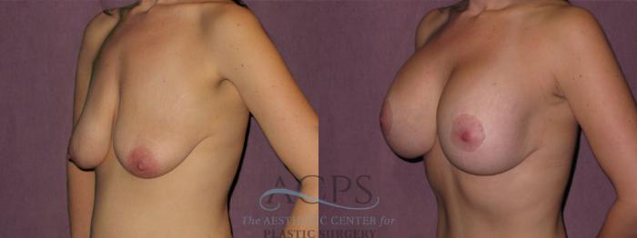 Before & After Breast Lift Case 1144 Oblique Left View: View in Houston, TX