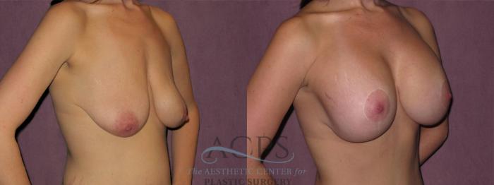 Before & After Breast Lift Case 1144 Oblique Right View: View in Houston, TX