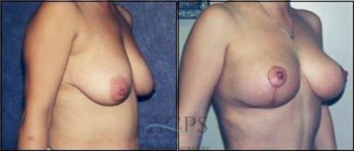 Before & After Breast Lift Case 1147 Oblique View: View in Houston, TX