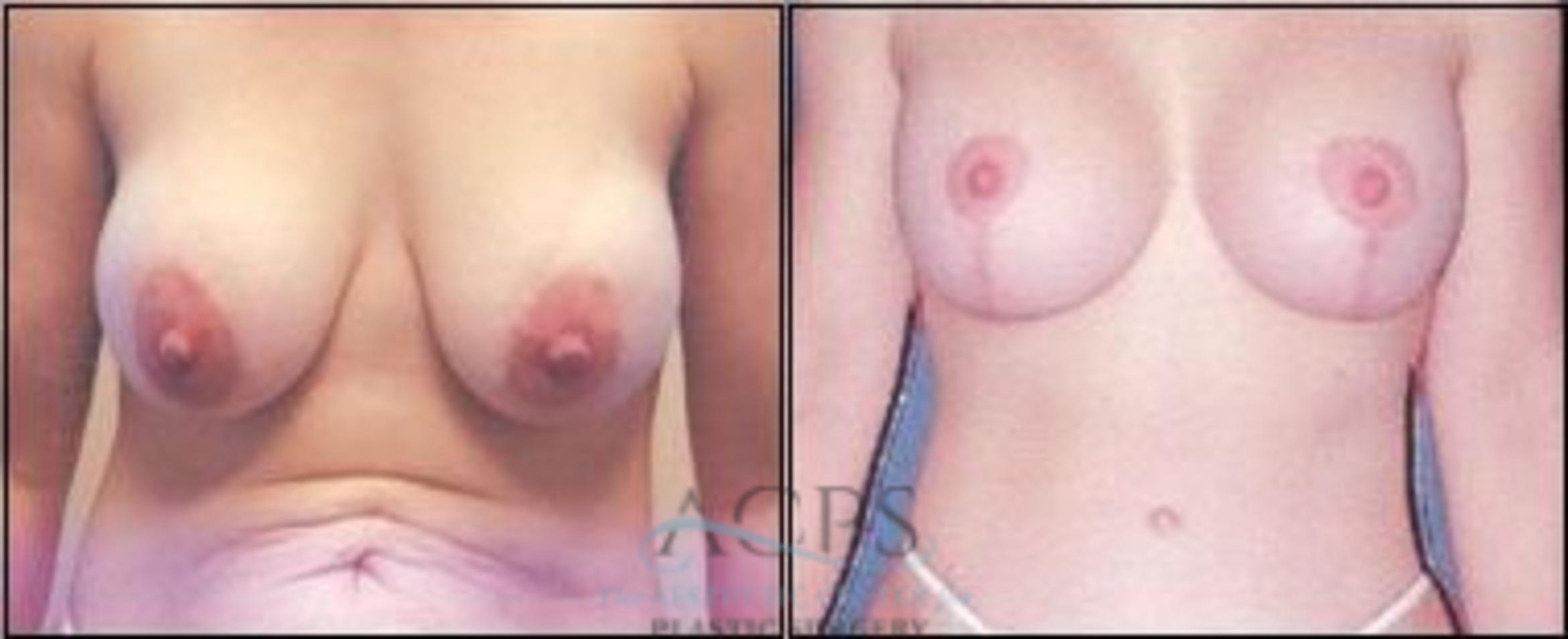 Before & After Breast Lift Case 1148 Front View: View in Houston, TX