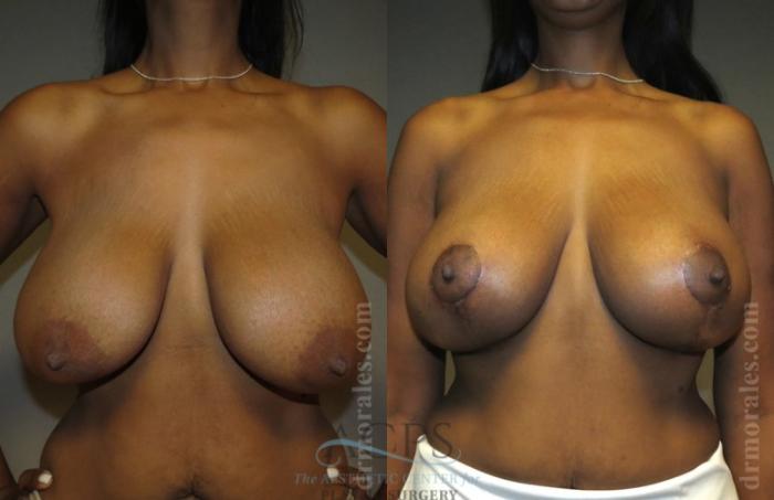 Before & After Breast Lift Case 1149 Front View: View in Houston, TX