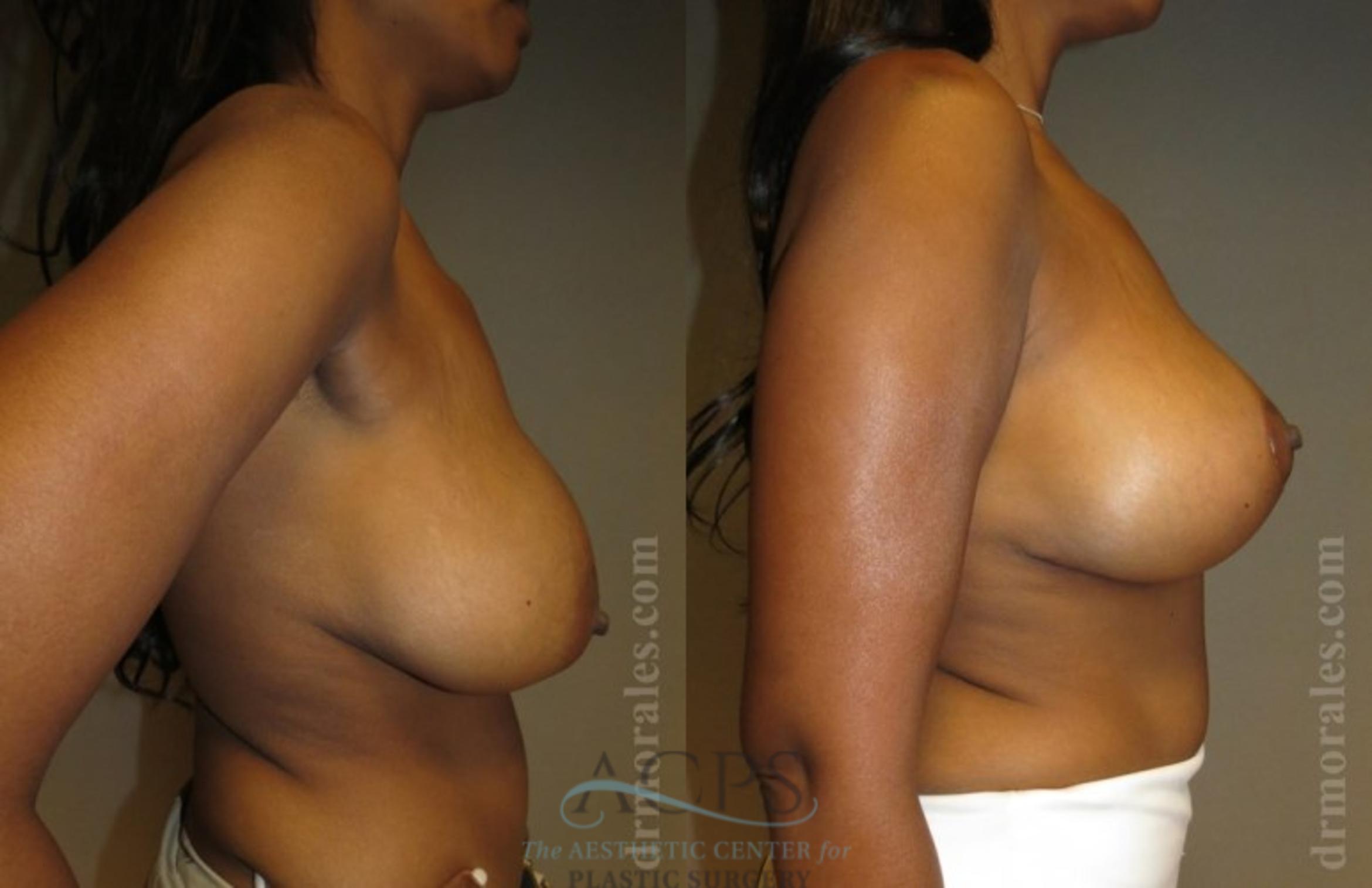Before & After Breast Lift Case 1149 Side View: View in Houston, TX