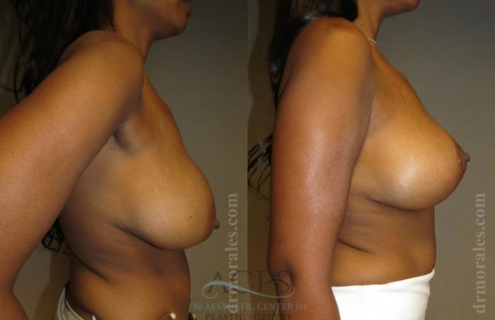 Before & After Breast Lift Case 1149 Side View: View in Houston, TX