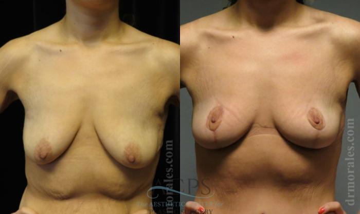 Before & After Breast Lift Case 1150 Front View: View in Houston, TX