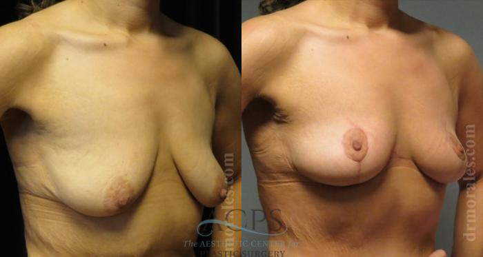 Before & After Breast Lift Case 1150 Oblique View: View in Houston, TX