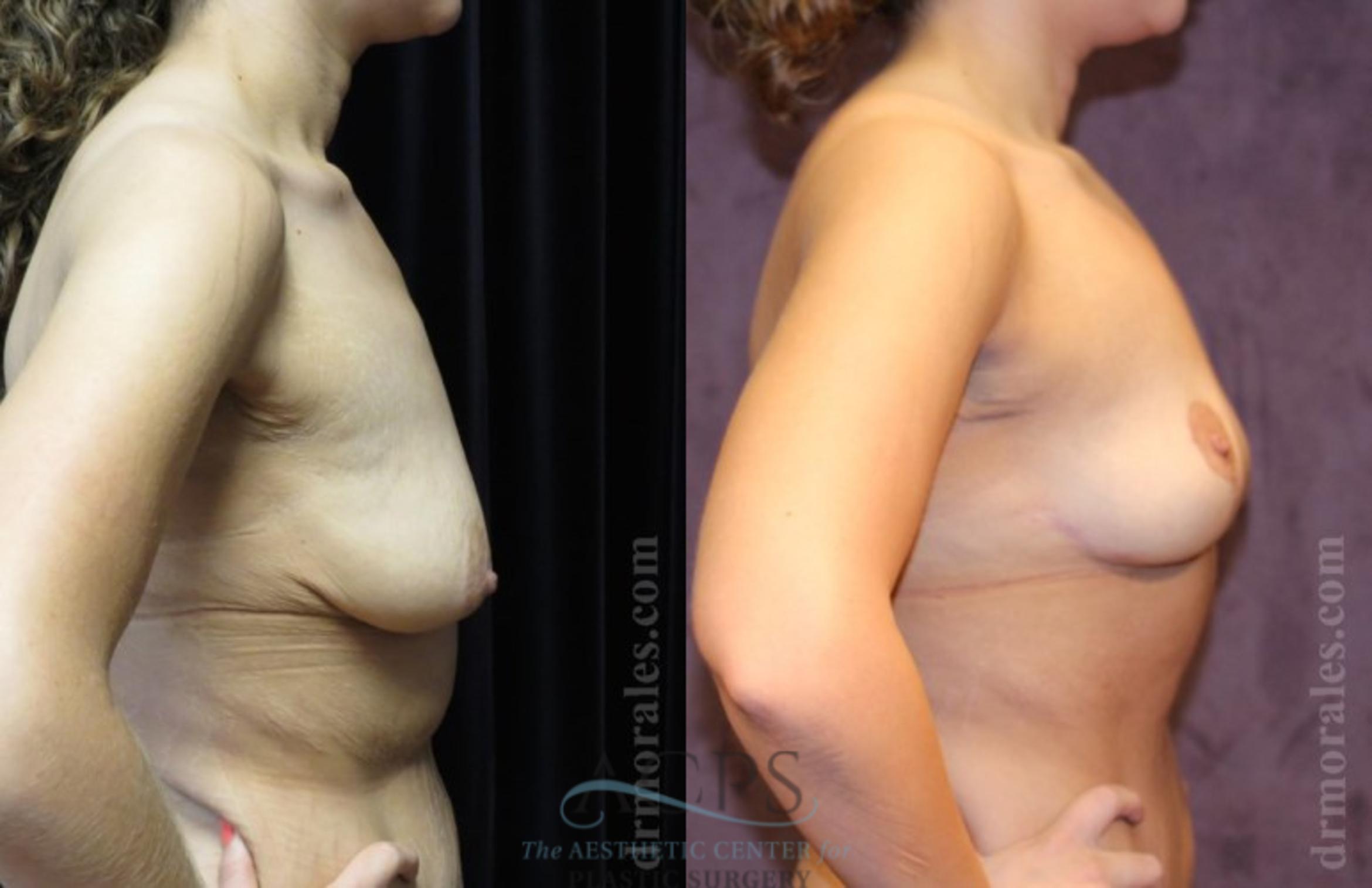 Before & After Breast Lift Case 1150 Side View: View in Houston, TX