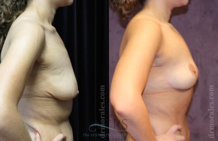 Before & After Breast Lift Case 1150 Side View: View in Houston, TX