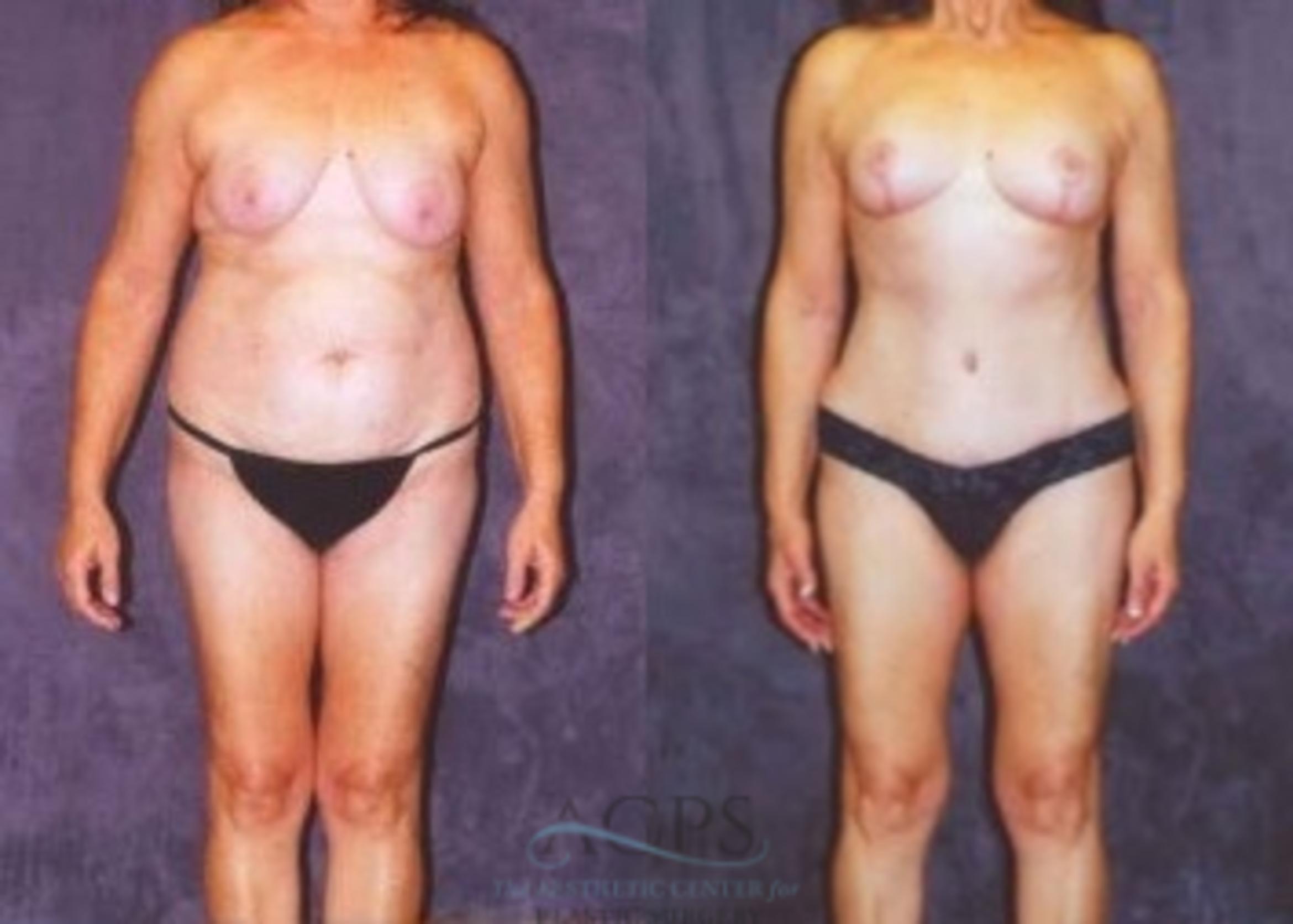 Before & After Breast Lift Case 1151 Front View: View in Houston, TX