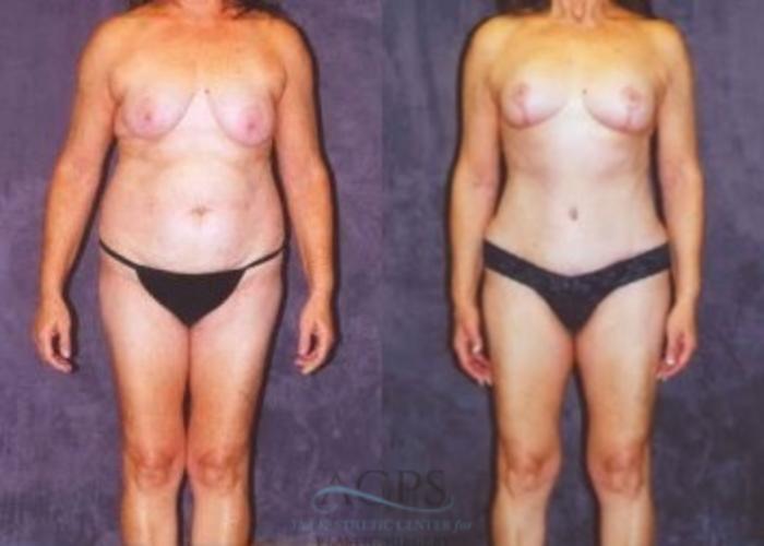 Before & After Breast Lift Case 1151 Front View: View in Houston, TX