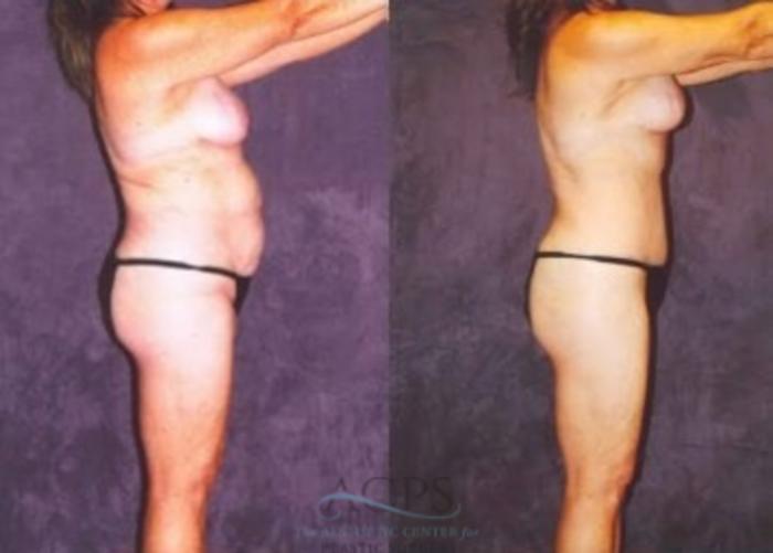 Before & After Breast Lift Case 1151 Side View: View in Houston, TX