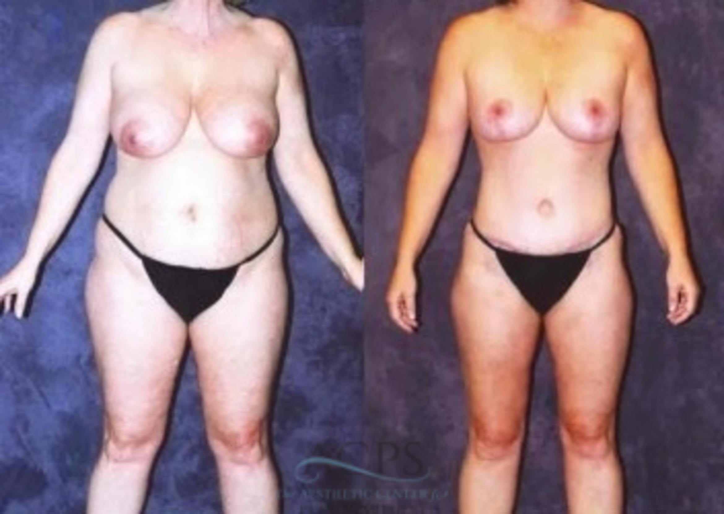 Before & After Breast Lift Case 1152 Front View: View in Houston, TX