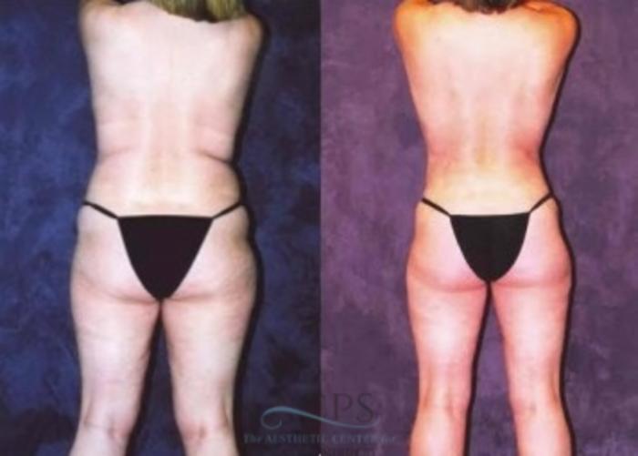 Before & After Breast Lift Case 1152 Rear View: View in Houston, TX