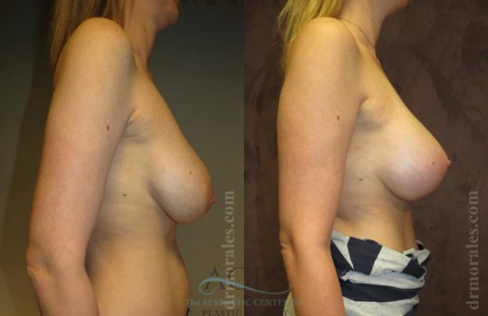 Before & After Breast Lift Case 1153 Side View: View in Houston, TX