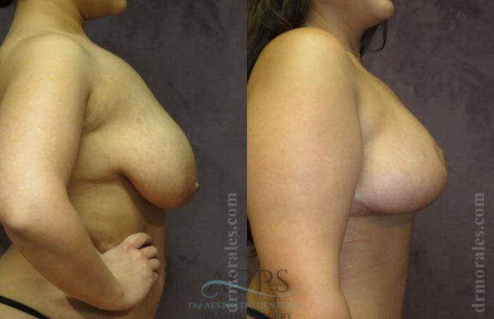 Before & After Breast Lift Case 1154 Side View: View in Houston, TX