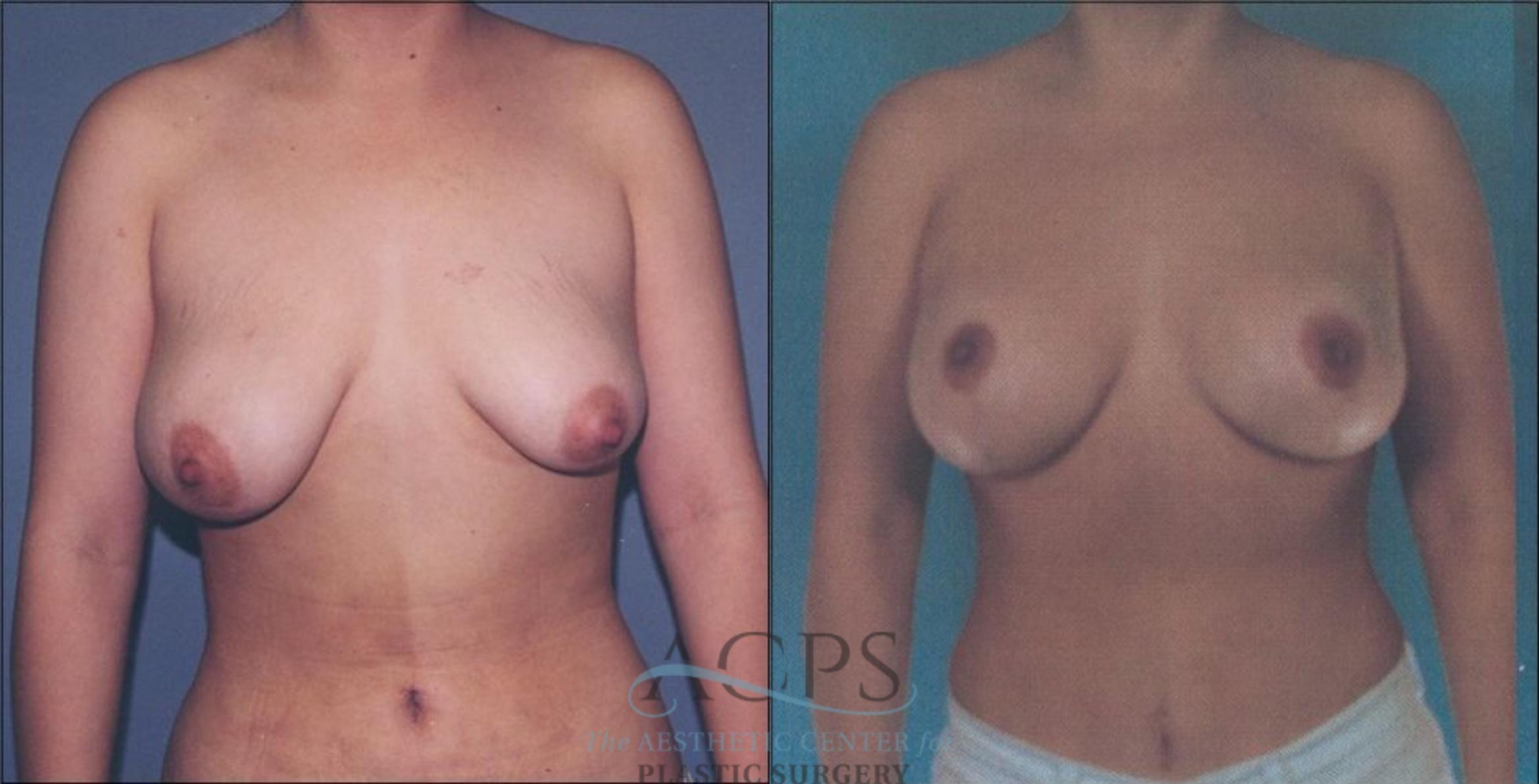Before & After Breast Lift Case 1155 Front View: View in Houston, TX