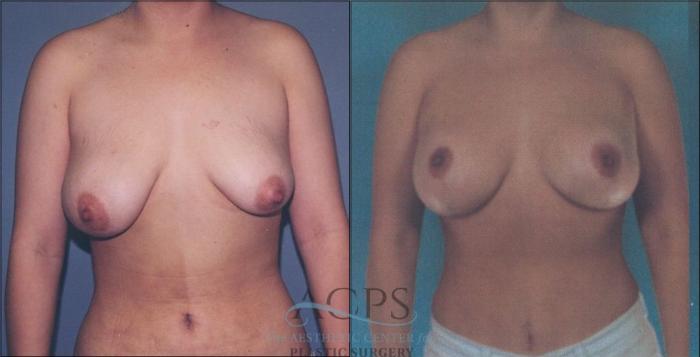 Before & After Breast Lift Case 1155 Front View: View in Houston, TX