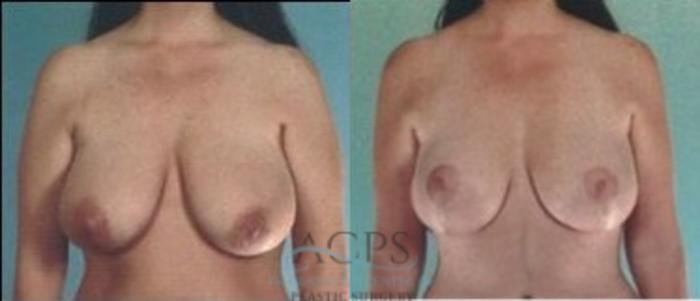 Before & After Breast Lift Case 1156 Front View: View in Houston, TX
