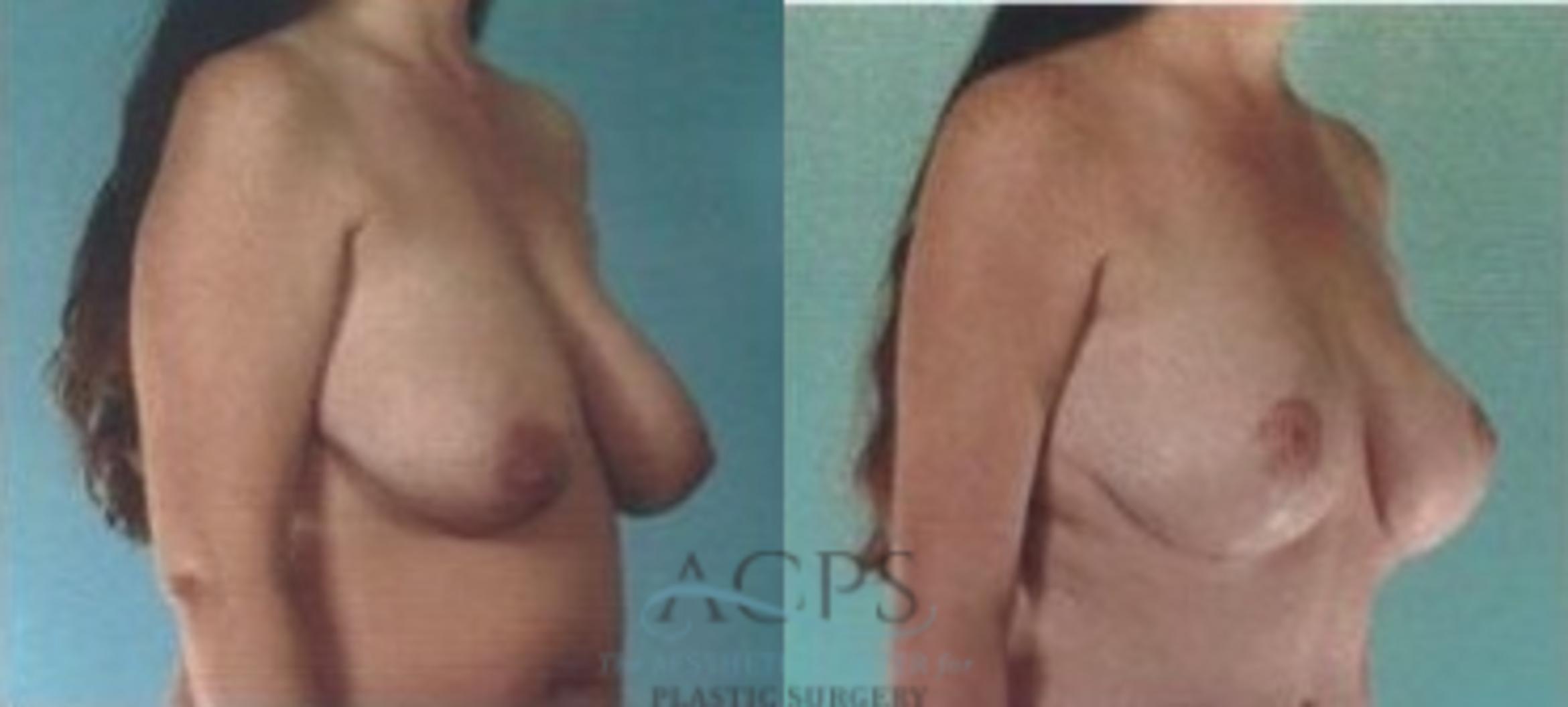 Before & After Breast Lift Case 1156 Side View: View in Houston, TX