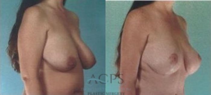 Before & After Breast Lift Case 1156 Side View: View in Houston, TX