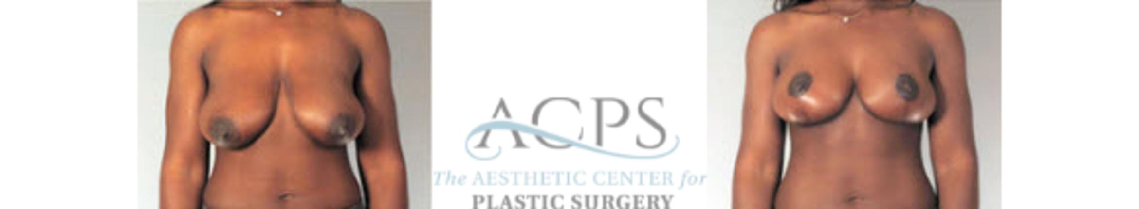 Before & After Breast Lift Case 1157 Front View: View in Houston, TX