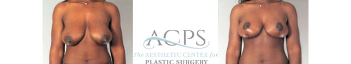 Before & After Breast Lift Case 1157 Front View: View in Houston, TX