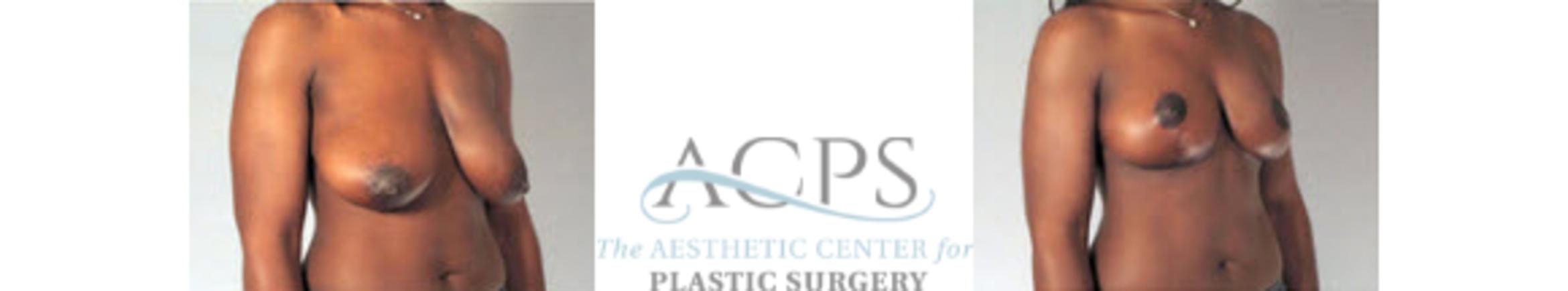 Before & After Breast Lift Case 1157 Oblique View: View in Houston, TX