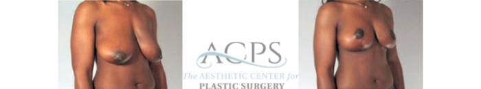 Before & After Breast Lift Case 1157 Oblique View: View in Houston, TX