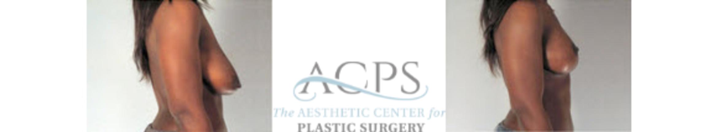 Before & After Breast Lift Case 1157 Side View: View in Houston, TX