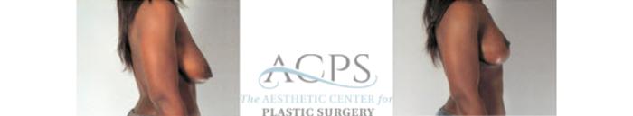 Before & After Breast Lift Case 1157 Side View: View in Houston, TX
