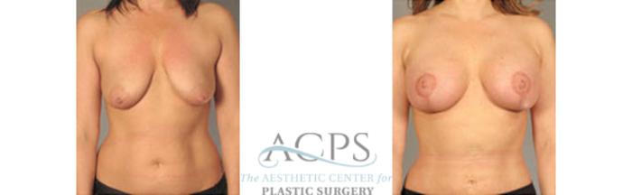 Before & After Breast Lift Case 1158 Front View: View in Houston, TX