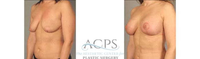 Before & After Breast Lift Case 1158 Oblique View: View in Houston, TX