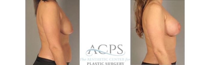 Before & After Breast Lift Case 1158 Side View: View in Houston, TX