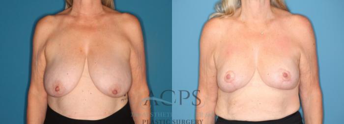 Before & After Breast Reduction Case 1519 Front View in Houston, TX