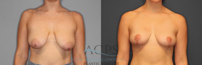 Before & After Breast Reduction Case 1159 Front View: View in Houston, TX