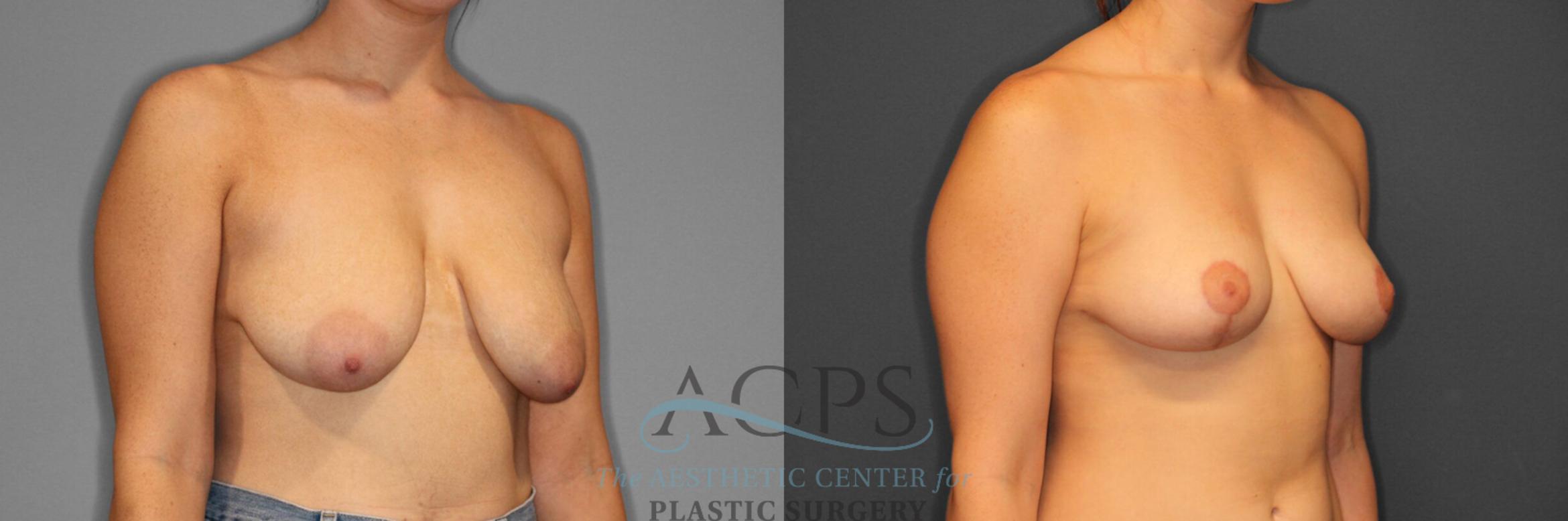 Before & After Breast Reduction Case 1159 Oblique View: View in Houston, TX