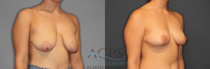 Before & After Breast Reduction Case 1159 Oblique View: View in Houston, TX