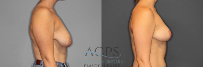 Before & After Breast Reduction Case 1159 Right Side View: View in Houston, TX