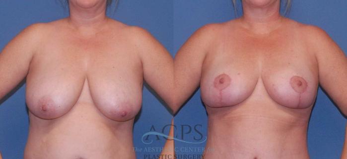Before & After Breast Reduction Case 1160 Front View: View in Houston, TX